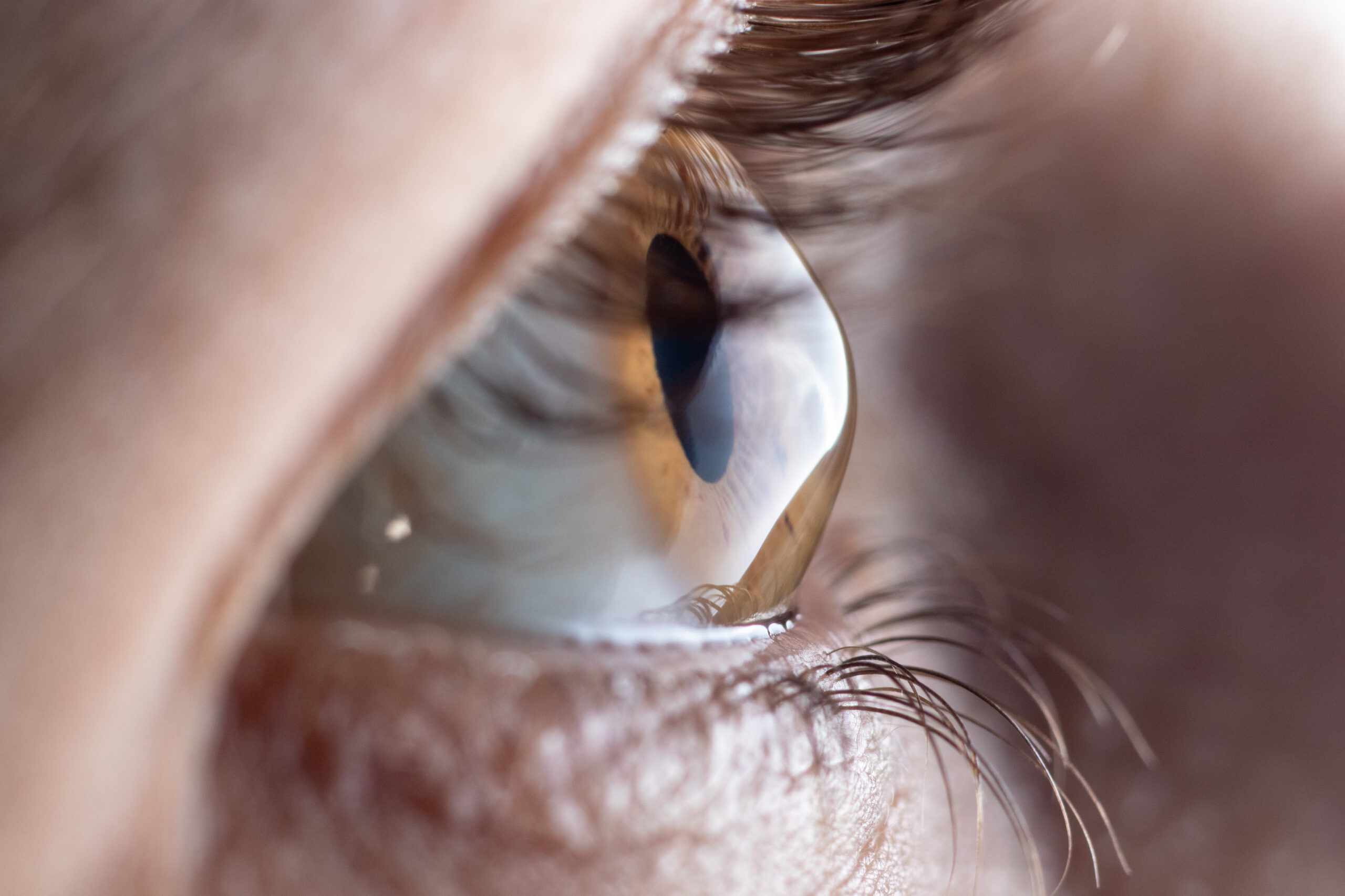 How to treat keratoconus